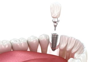 a computer design showing how an implant crown works