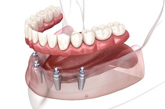 a computer design showing how implant dentures work
