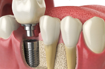 a computer illustration of an implant crown