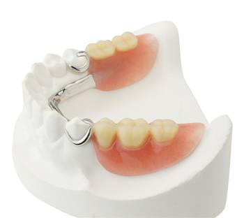 Partial denture on smile model