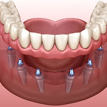 Rendering of implant dentures in lower arch with faded pink background