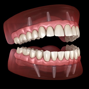 Implant-retained dentures