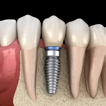 dental implant