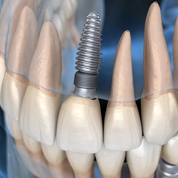 model of dental implant