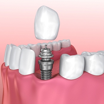 parts of dental implants