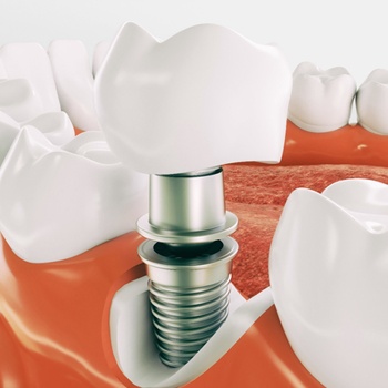 model of dental implant