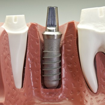 dental implant post