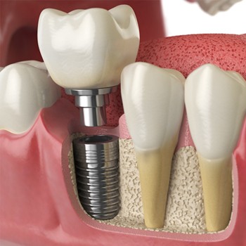 parts of a dental implant