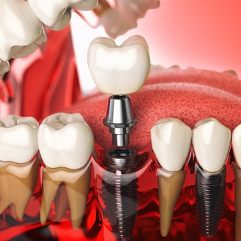 dental implant