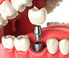 illustration of dental implants