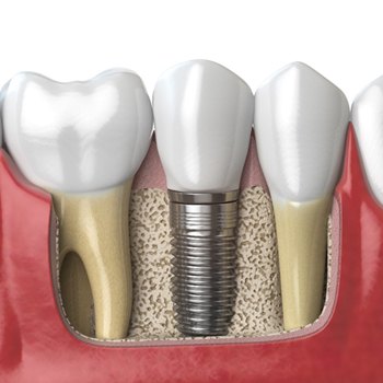 A single tooth dental implant