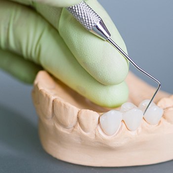 dental bridge crowns dentist