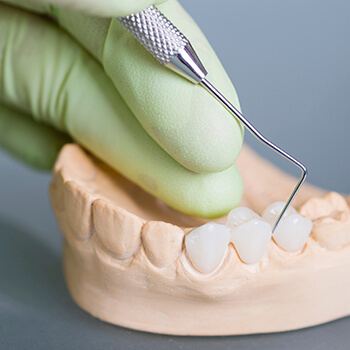 Dental Bridges