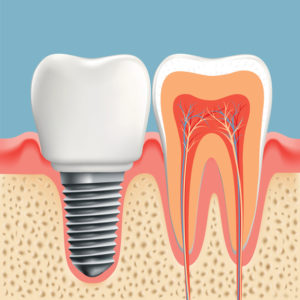 Regain a complete smile with dental implants in Crown Point.