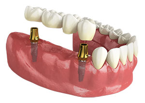 Four unit bridge over two dental implants.