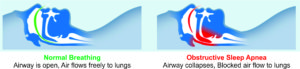 Diagram of airflow with Obstructive Sleep Apnea.