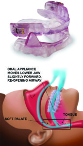 Oral Appliance used to maintain open airway.