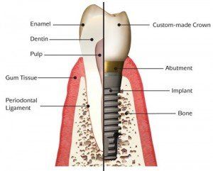 Image of anatomy of a dental implant.