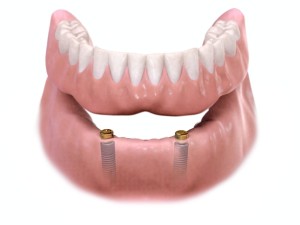 Implant Overdenture
