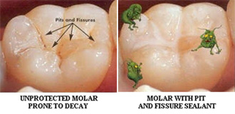 Dental Sealants protect the teeth from cavity forming bacteria.