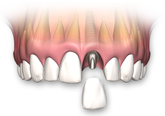 Single tooth implant